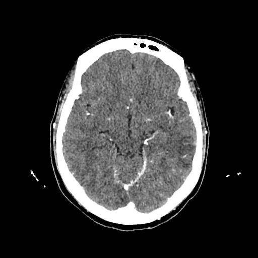 File:Cerebral venous thrombosis with venous hemorrhagic infarct (Radiopaedia 90354-107660 Axial with contrast 70).jpg