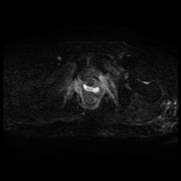 File:Cervical carcinoma (Radiopaedia 70924-81132 Axial DWI 34).jpg