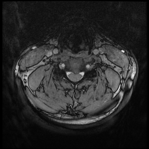 Cervical disc extrusion (Radiopaedia 59074-66364 G 42).jpg