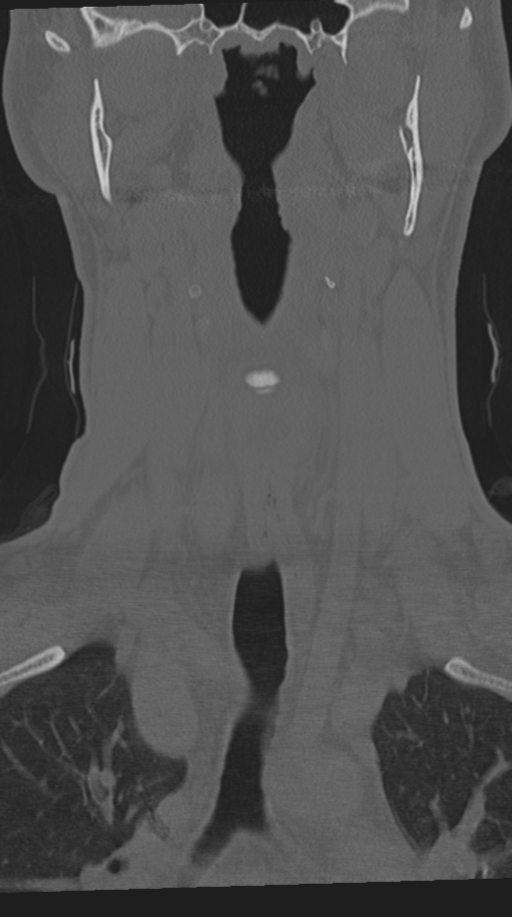 Cervical intercalary bone (Radiopaedia 35211-36748 Coronal bone window 22).png