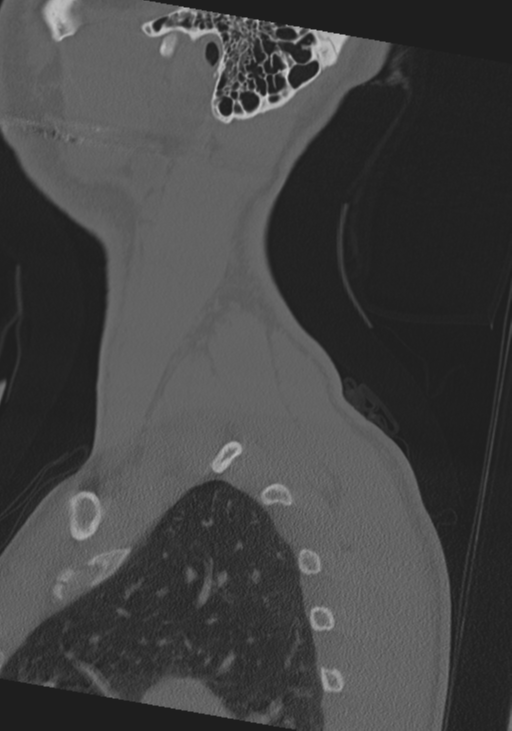 Cervical intercalary bone (Radiopaedia 35211-36748 Sagittal bone window 3).png