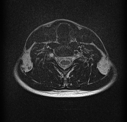 File:Cervical spondylodiscitis and calvarial hemangioma (Radiopaedia 64317-73104 Axial T2 16).jpg