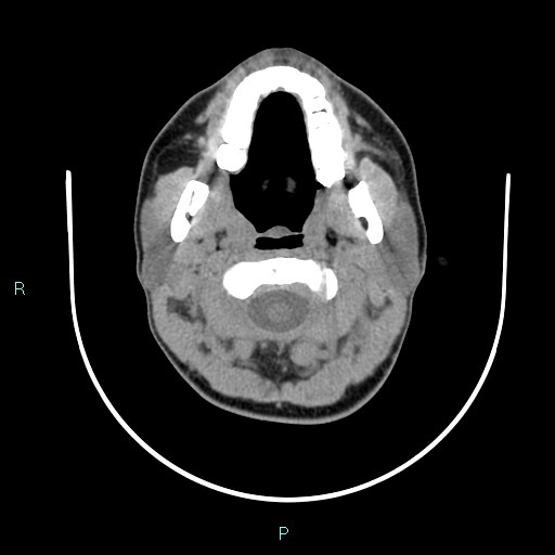 File:Cervical thymic cyst (Radiopaedia 88632-105335 Axial non-contrast 90).jpg