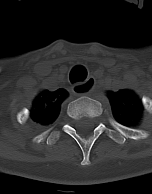 Cervical tuberculous spondylitis (Radiopaedia 39149-41365 Axial bone window 48).png