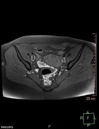 File:Cesarian scar endometriosis (Radiopaedia 68495-78066 Axial T1 fat sat 10).jpg