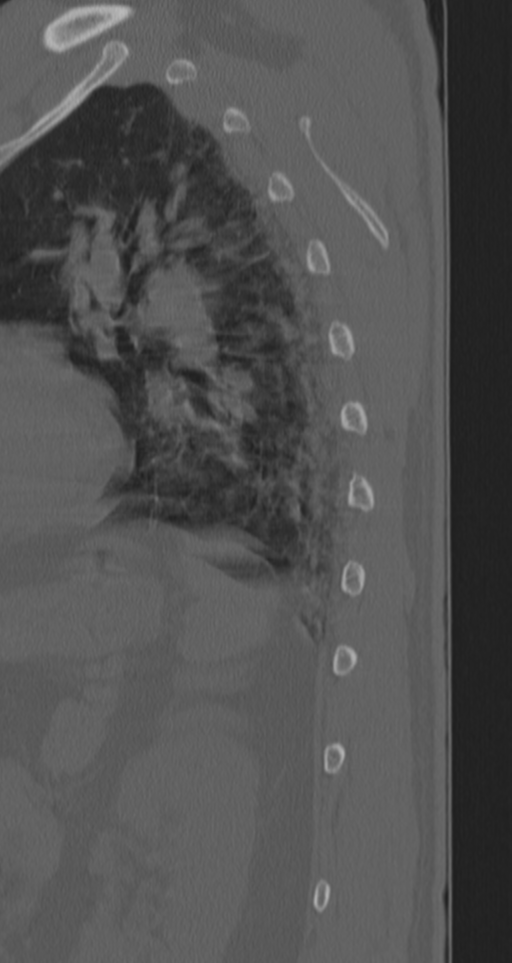 Chance fracture (Radiopaedia 33854-35020 Sagittal bone window 8).png
