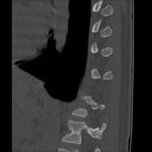 Chance fracture (Radiopaedia 36521-38081 Sagittal bone window 56).jpg