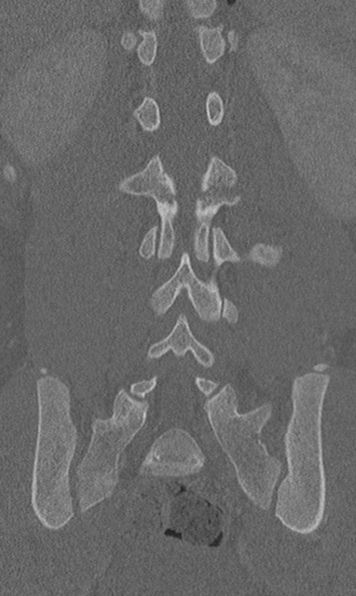 Chance fracture (Radiopaedia 40360-42912 Coronal bone window 45).png