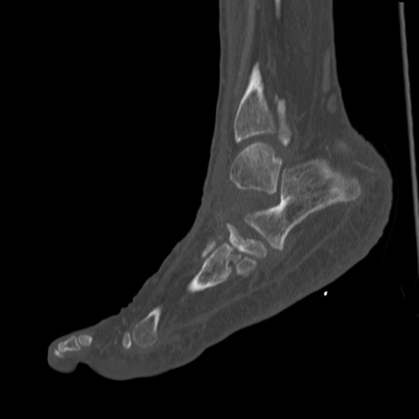 File:Charcot joint (Radiopaedia 36629-38194 Sagittal bone window 36).jpg