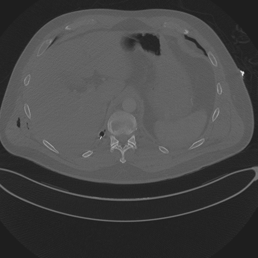 Chest multitrauma - aortic injury (Radiopaedia 34708-36147 Axial bone window 278).png