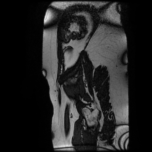 File:Chiari II malformation - fetal MRI (Radiopaedia 68099-77581 Sagittal Fiesta 1).jpg