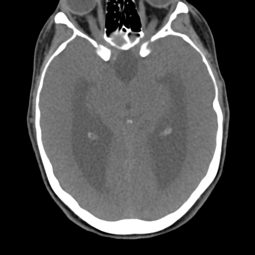 Chiari I malformation and obstructive hydrocephalus (Radiopaedia 41185-43981 D 15).png
