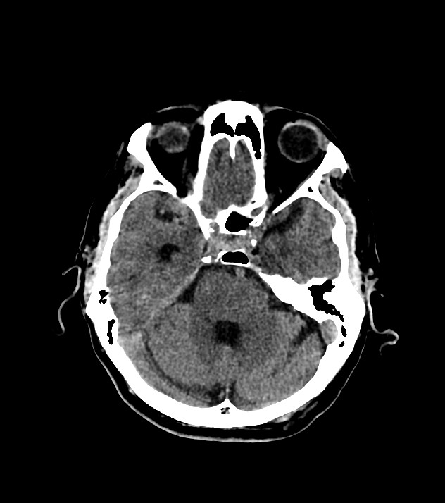 Cholangiocarcinoma with cerebral metastases (Radiopaedia 83519-98628 Axial non-contrast 24).jpg