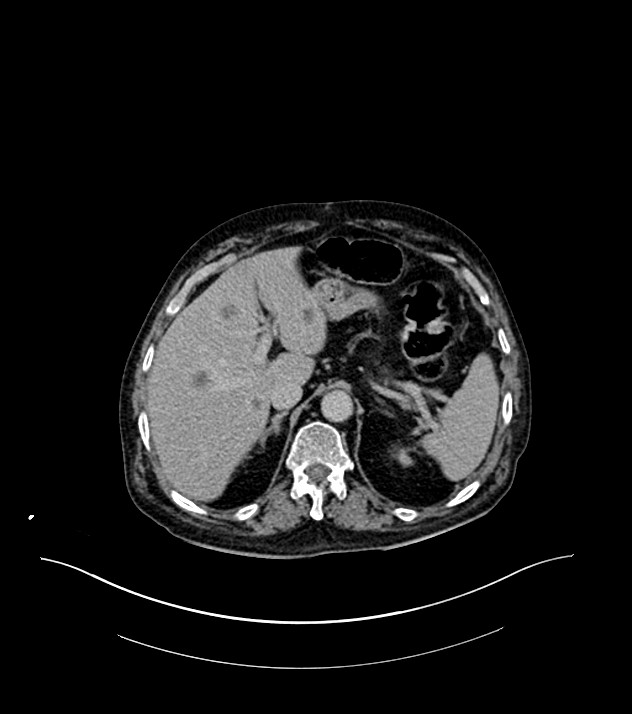 Cholangiocarcinoma with cerebral metastases (Radiopaedia 83519-98629 Axial C+ delayed 25).jpg