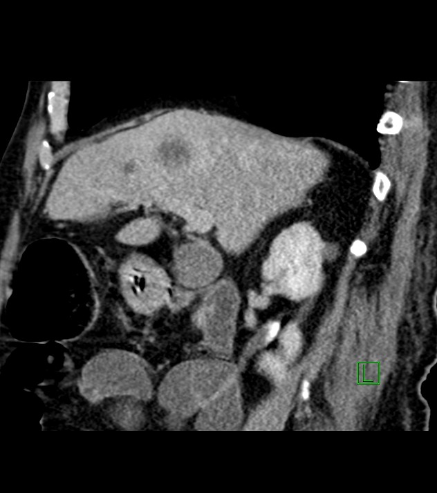 Cholangiocarcinoma with cerebral metastases (Radiopaedia 83519-98629 Sagittal C+ delayed 72).jpg