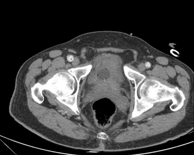 Cholecystitis - perforated gallbladder (Radiopaedia 57038-63916 A 79).jpg
