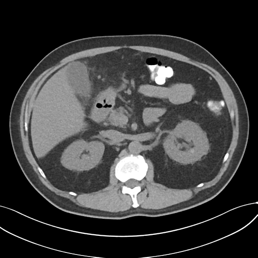 Cholecystitis with focal perforation and hepatic abscess (Radiopaedia 37189-38945 Axial non-contrast 31).png