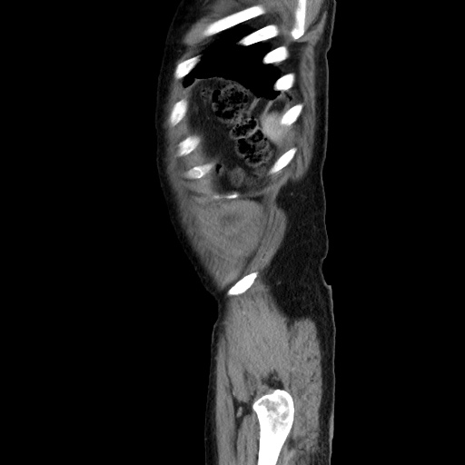 Choledocholiathiasis with normal caliber common bile duct (Radiopaedia 75368-86632 D 143).jpg