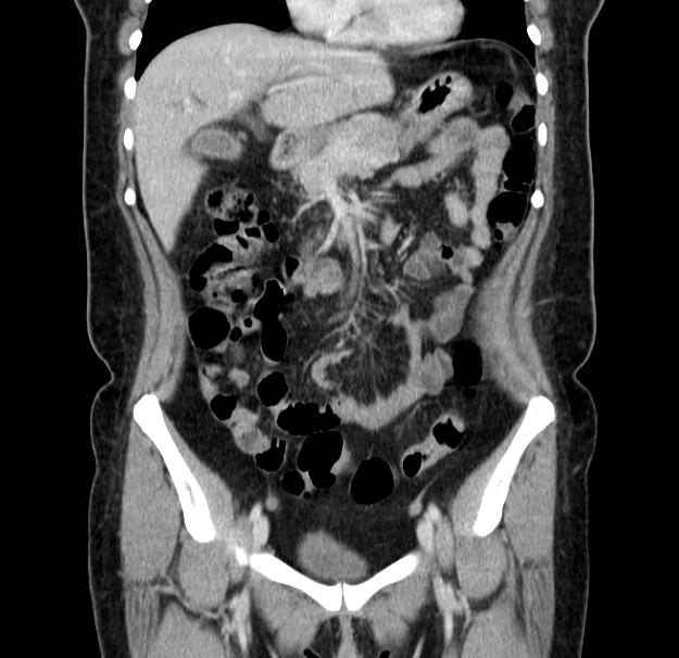 Choledocholithiasis on CT and MRI (Radiopaedia 24825-25087 C 19).jpg