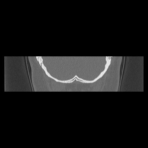 Cholesteatoma (Radiopaedia 84946-100455 Coronal bone window 149).jpg