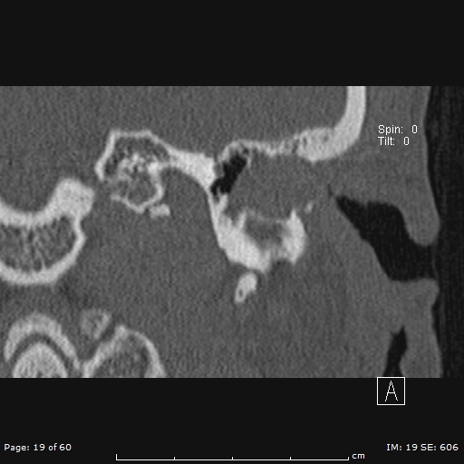 Cholesteatoma - external auditory canal (Radiopaedia 88452-105096 Coronal bone window 19).jpg