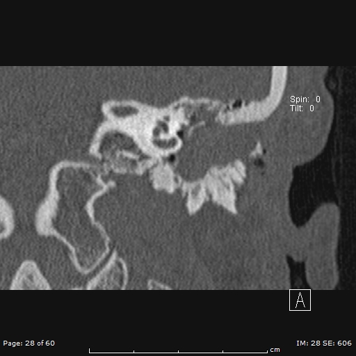 File:Cholesteatoma - external auditory canal (Radiopaedia 88452-105096 Coronal bone window 28).jpg