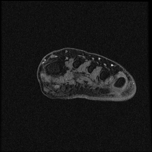 File:Chondroblastoma - midfoot (Radiopaedia 64831-73765 F 30).jpg