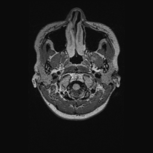 Chondrosarcoma (Radiopaedia 41937-44939 Axial FLAIR 7).png