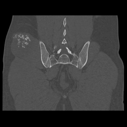 Chondrosarcoma of iliac wing (Radiopaedia 63861-72599 Coronal bone window 90).jpg
