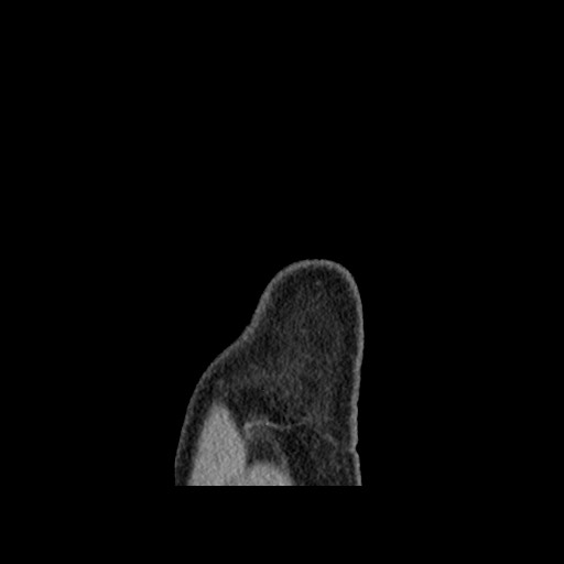 File:Chondrosarcoma of iliac wing (Radiopaedia 63861-72599 F 177).jpg