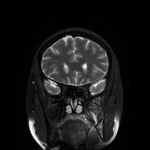 File:Chordoid glioma of third ventricle (Radiopaedia 91612-109340 Coronal T2 8).jpg