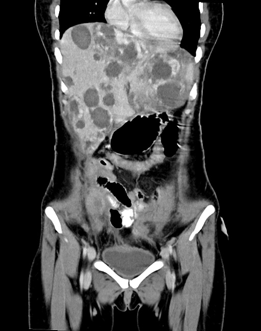 Choriocarcinoma liver metastases (Radiopaedia 74768-85766 B 34).jpg