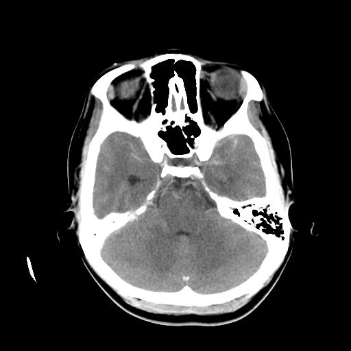 File:Choriocarcinoma of ovary with cerebral and pulmonary metastases (Radiopaedia 25983-26118 A 7).jpg