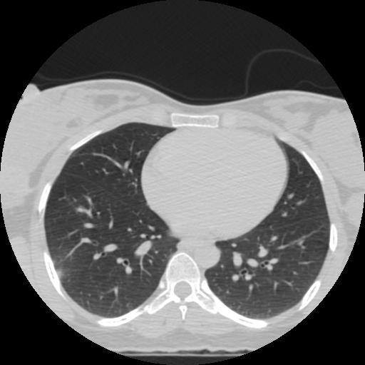 File:Choriocarcinoma of ovary with cerebral and pulmonary metastases (Radiopaedia 25983-26119 Axial lung window 1).jpg