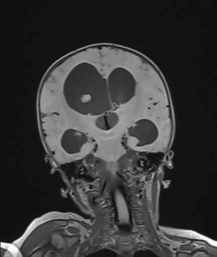 Choroid plexus papilloma (Radiopaedia 84612-100019 Coronal FLAIR 71).jpg