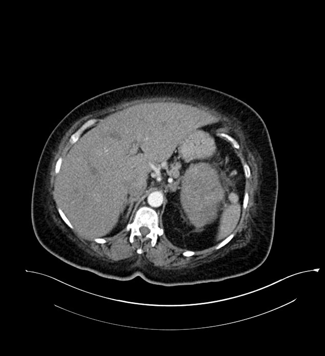 Chromophobe renal cell carcinoma (Radiopaedia 84239-99519 B 28).jpg