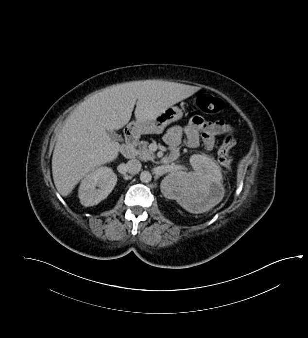 Chromophobe renal cell carcinoma (Radiopaedia 84239-99519 E 69).jpg