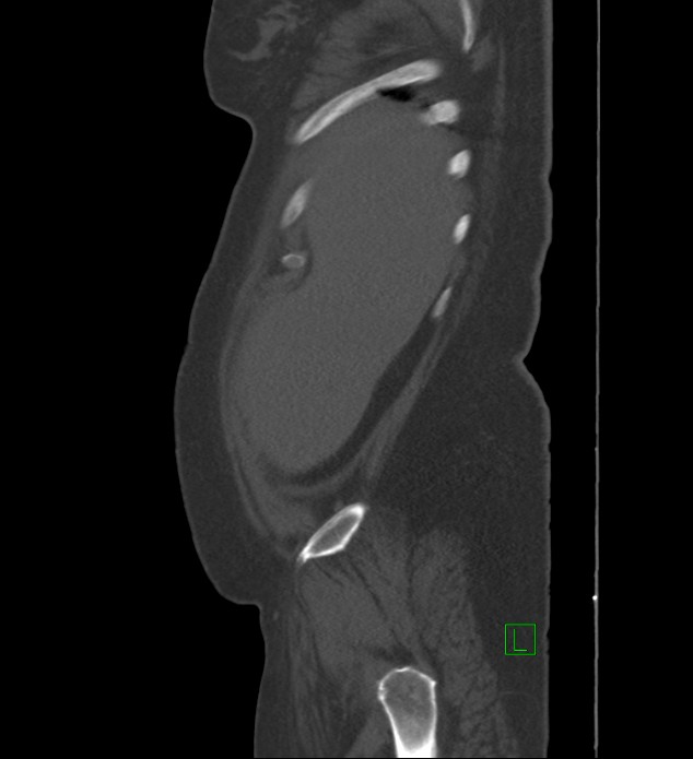 Chromophobe renal cell carcinoma (Radiopaedia 84239-99519 Sagittal bone window 96).jpg