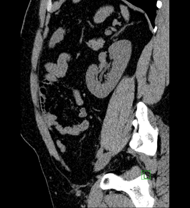 Chromophobe renal cell carcinoma (Radiopaedia 84286-99573 C 54).jpg