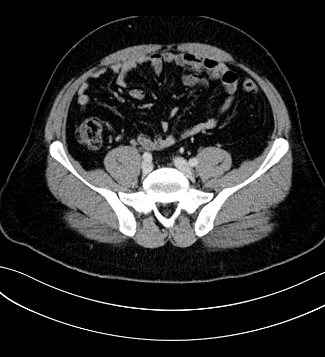 Chromophobe renal cell carcinoma (Radiopaedia 84286-99573 G 51).jpg
