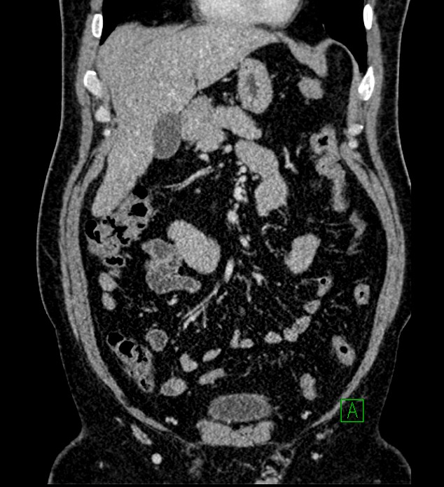 Chromophobe renal cell carcinoma (Radiopaedia 84286-99573 H 58).jpg