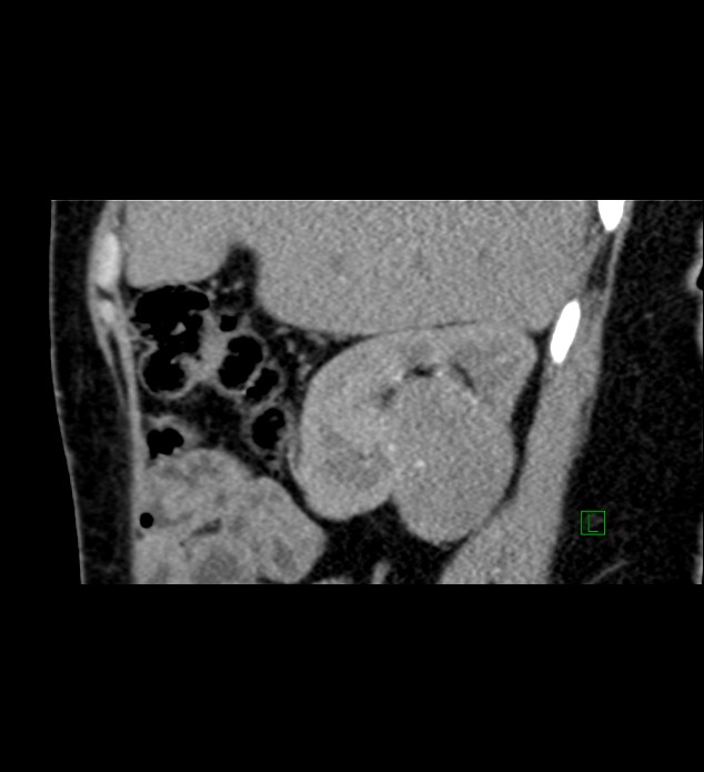 Chromophobe renal cell carcinoma (Radiopaedia 84290-99582 D 72).jpg