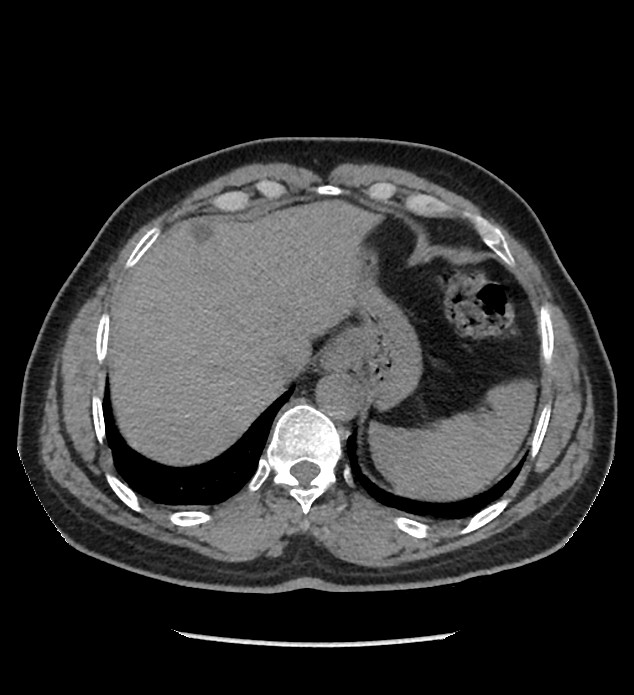 Chromophobe renal cell carcinoma (Radiopaedia 86879-103083 Axial non-contrast 4).jpg