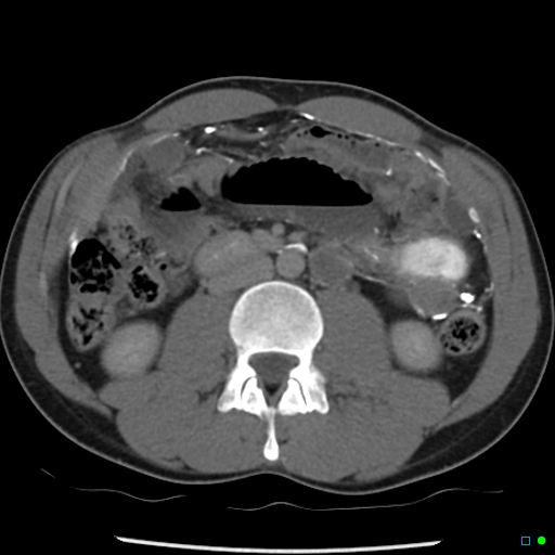 File:Chronic barium peritonitis and small bowel obstruction (Radiopaedia 29151-29548 D 6).jpg