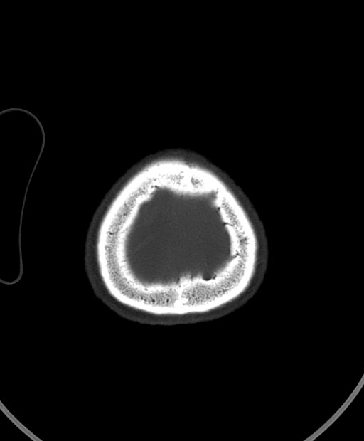 Chronic bilateral subdural hygroma (Radiopaedia 85801-101623 Axial bone window 17).jpg