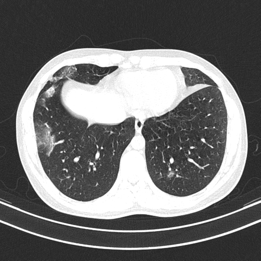 Chronic eosinophilic pneumonia (Radiopaedia 39331-41587 Axial lung window 42).png