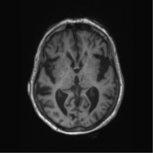 Chronic hypertensive encephalopathy (Radiopaedia 72844-83495 Axial T1 38).png
