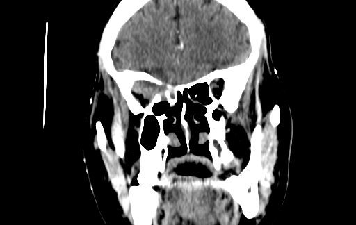 Chronic invasive fungal sinusitis (Radiopaedia 91563-109286 D 56).jpg