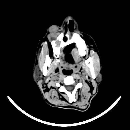 File:Chronic invasive fungal sinusitis with intraorbital and intracranial extension (Radiopaedia 56387-63046 Axial non-contrast 28).jpg