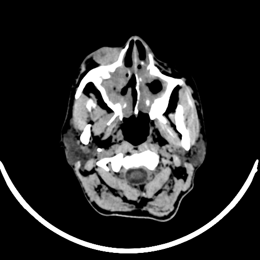 Chronic invasive fungal sinusitis with intraorbital and intracranial extension (Radiopaedia 56387-63046 Axial non-contrast 55).jpg